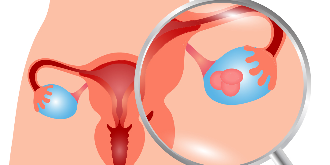PCOS_01_web